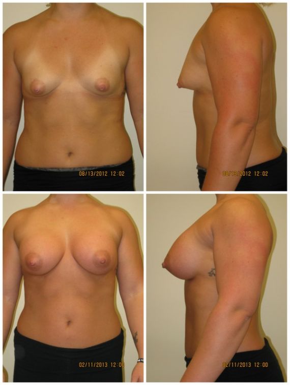 Breast augmentation, supra-pectoral, with 400cc silicone gel implants, age 26