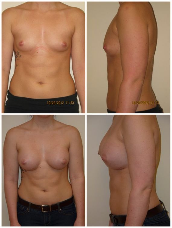 Breast augmentation with 450cc silicone gel implants, age 24