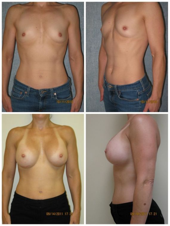 Breast augmentation with silicone gel implants, 525cc on the right, 550cc on the left, age 42