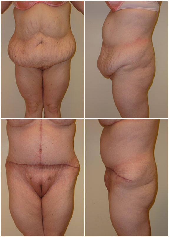 Panniculectomy, Age 40, pre-op weight 153