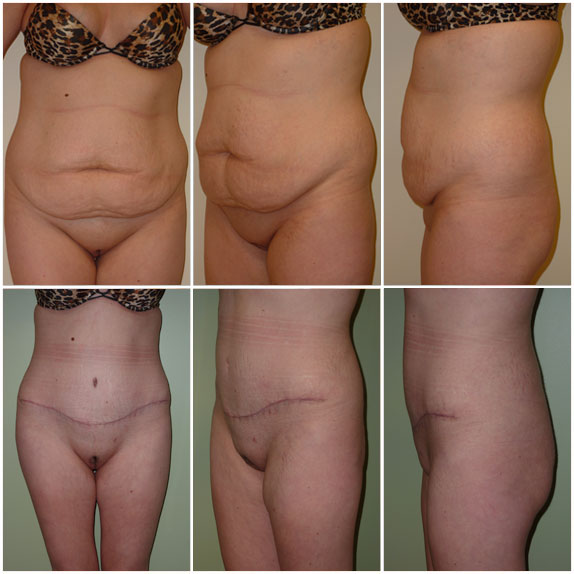 Abdominoplasty, Liposuction abdomen, flanks Age 28, pre-op weight 140