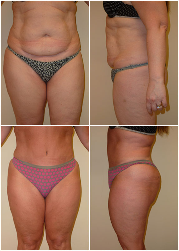 Abdominoplasty, Liposuction abdomen, flanks Age 54, pre-op weight 170