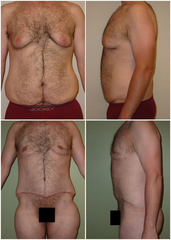 Abdominoplasty, Liposuction flanks, Mastectomy, Liposuction of breasts Age 31, pre-op weight 203