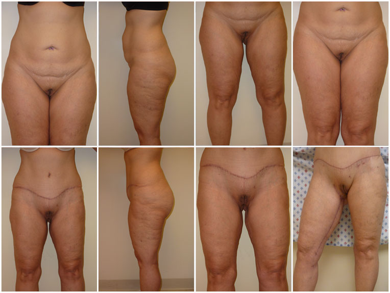 Abdominoplasty, Liposuction abdomen, thighs, Bilateral Medial Thigh Lift Age 44, pre-op weight 140