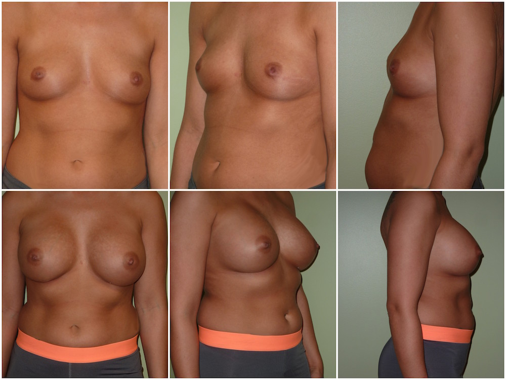 Breast Augmentation Patient 35