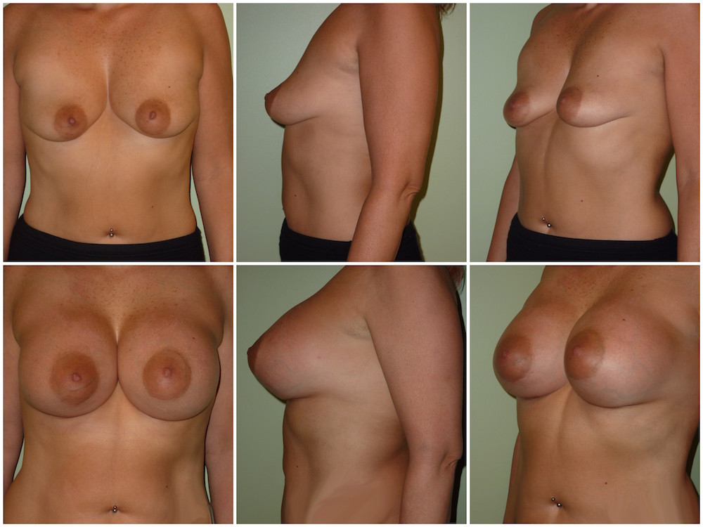 Breast Augmentation with 650cc textured round high profile silicone gel imp...