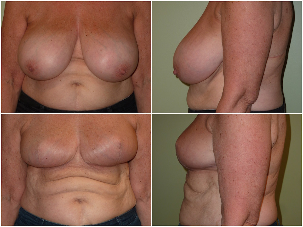 Breast Reduction Patient 9