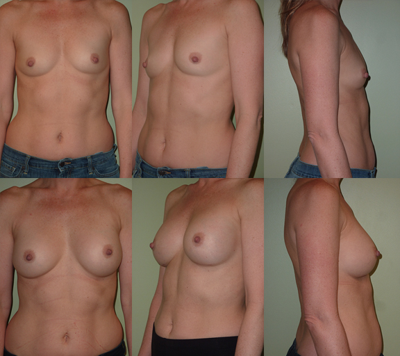 Breast Augmentation with 300cc moderate plus profile silicone gel implants, age 44