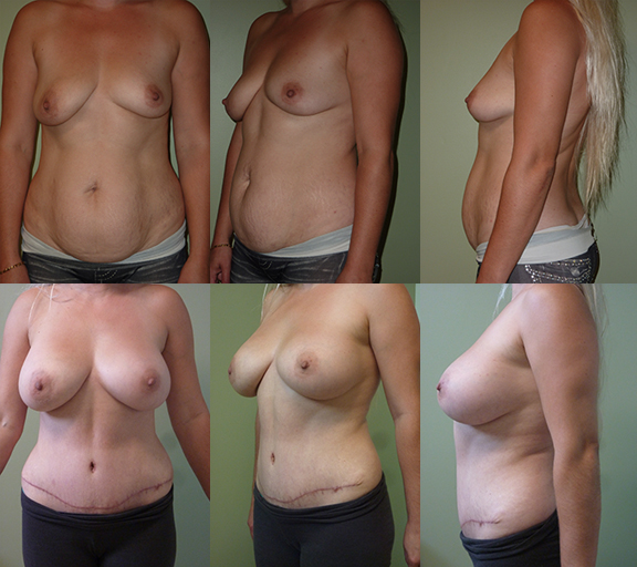 Age 35, 3 children, pre-op weight 145 lbs Abdominoplasty with Breast Augmentation