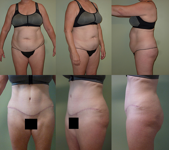 Age 62, 2 children, pre-op weight 150 lbs Abdominoplasty with Liposuction Flanks