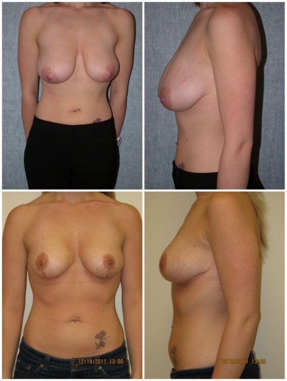 Bilateral reduction mammaplasty, age 29