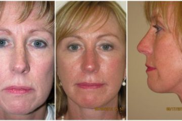 Face and neck lift, age 51