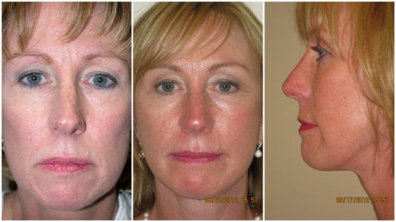 Face and neck lift, age 51