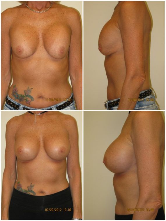Replacement with 400cc silicone gel implants, age 50