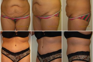 Age 48, 4 children, pre-op weight 146: