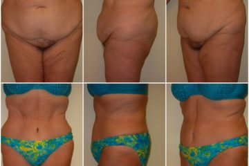 Age 54, 0 children, pre-op weight 185: