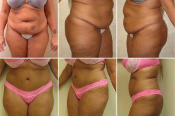 Age 44, 2 children, pre-op weight 200 lbs.