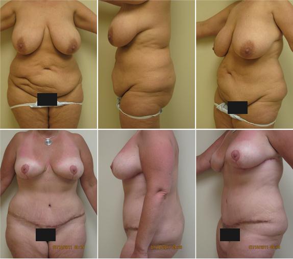 Breast Reduction w/ Abdominoplasty, Age 44