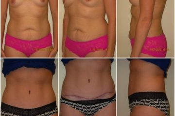 Age 44, 4 children, pre-op weight 138