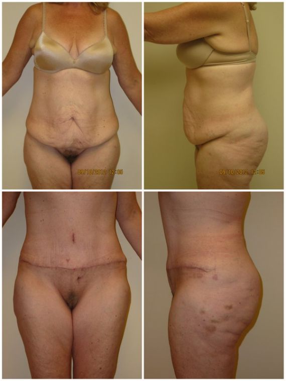 Abdominoplasty and breast augmentation with 400cc silicone gel implants, age 46