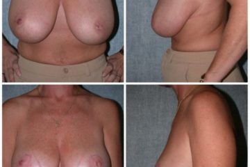 Bilateral reduction mammaplasty, age 44
