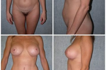 Age 49, 1 child, pre-op weight 148 lbs: