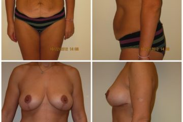 Tummy Tuck and Bilateral Wise Patter mastopexy for Grade III ptosis, age 32, 2 children, pre-op weight 119 lbs