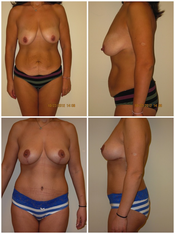 Tummy Tuck and Bilateral Wise Patter mastopexy for Grade III ptosis, age 32, 2 children, pre-op weight 119 lbs