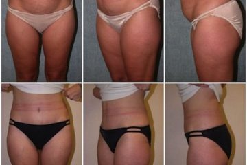 Age 48, 2 children, pre-op weight 108 lbs