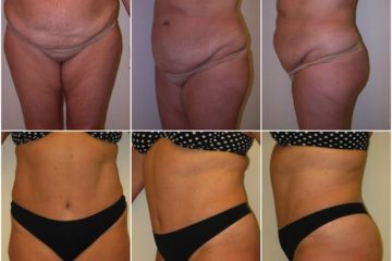 Age 49, 3 children, pre-op weight 185