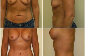 Age 50, 2 children, pre-op weight 130 lbs.