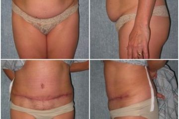 Age 53, 3 children, pre-op weight 135 lbs