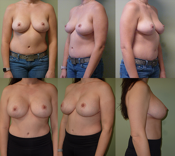 Breast augmentation with 405cc moderate plus profile silicone gel implants, age 37
