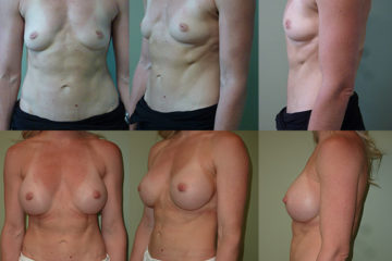 Breast augmentation with 400cc high profile silicone gel implants, age 34