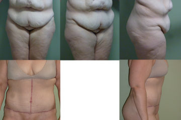 Panniculectomy with inverted T, age 40, 3 children 130 lb weight loss