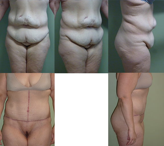 Panniculectomy with inverted T, age 40, 3 children 130 lb weight loss