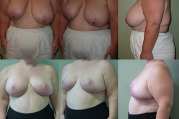 Bilateral Wise Pattern breast reduction, age 54, 2 children