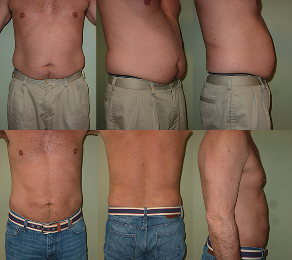 Liposuction to abdomen and bilateral flanks, age 52