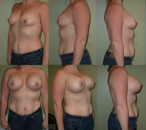 Breast augmentation with 600cc high profile silicone gel implants, age 32