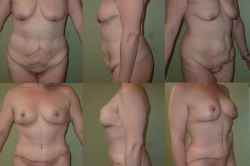 Abdominoplasty (post-op photos at 3 months), age 34, 1 child, 158 lb weight loss