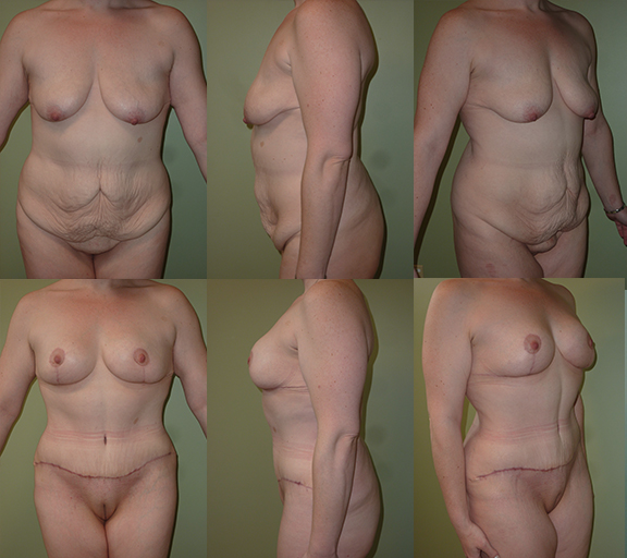 Abdominoplasty (post-op photos at 3 months), age 34, 1 child, 158 lb weight loss