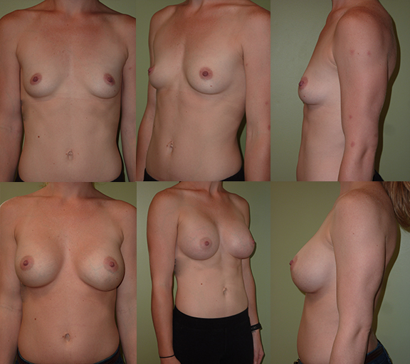 Breast augmentation with 400cc moderate plus profile silicone gel implants, age 26
